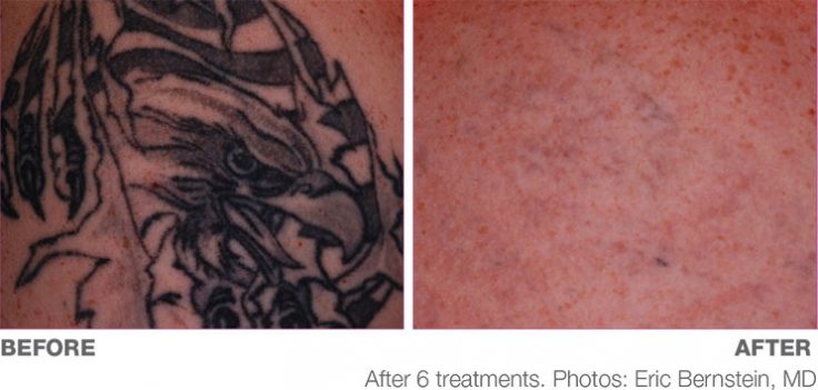 Picoway Tattoo Removal – Dr. D. Neal Mastruserio, Md, Llc